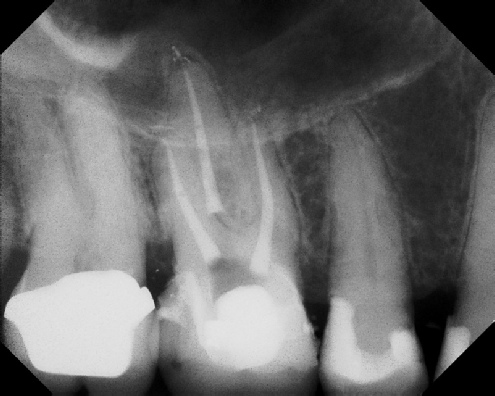 Root Canal with Calcified Canals - Meriden