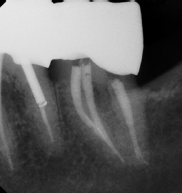 Root Canal - Access Through Crown