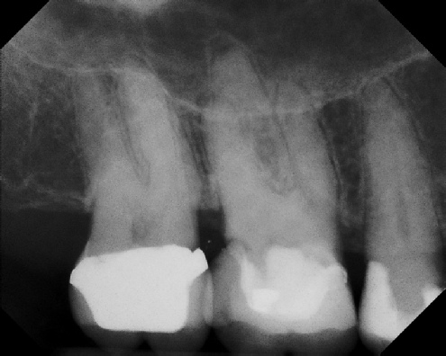 Root Canal with Calcified Canals - Meriden