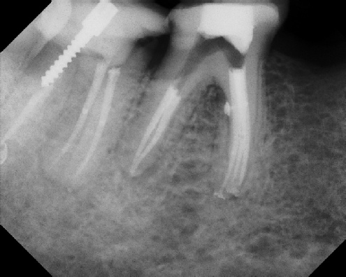 root canal anatomy - Stratford