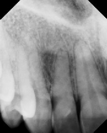 Root Canal with Calcified Canals - Stratford