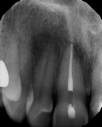 Root Canal with Calcified Canals - Stratford